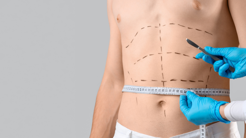 Haeckel Cabral Moraes ressalta que a miniabdominoplastia exige planejamento detalhado para corrigir flacidez específica.